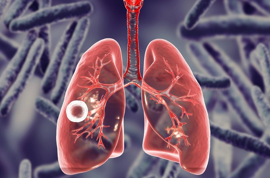 Врач-эпидемиолог рассказала, какие факторы способствуют развитию туберкулёза